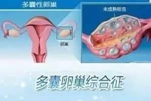 多囊卵巢综合征,试管婴儿条件