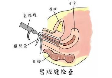 子宫肌瘤