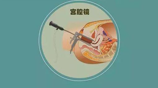 子宫肌瘤