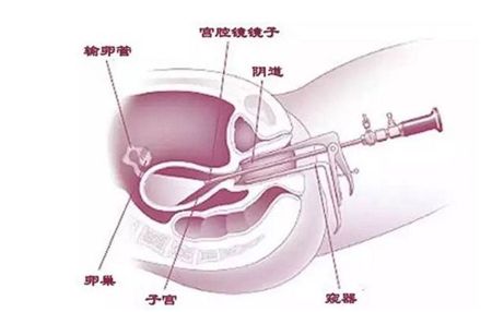 输卵管不通,输卵管不通做试管