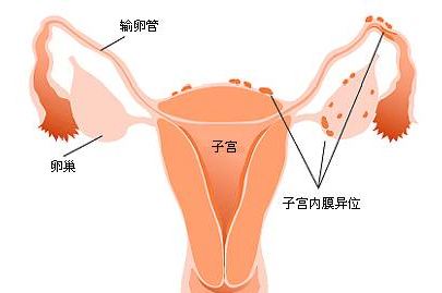 试管婴儿中该如何选择冻胚移植内膜准备方案？