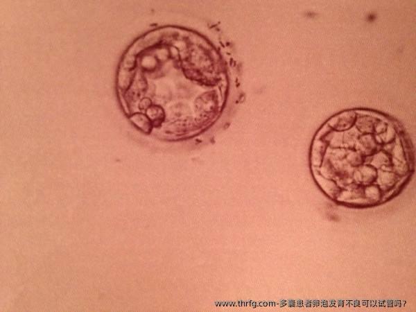 多囊患者卵泡发育不良可以试管吗？
