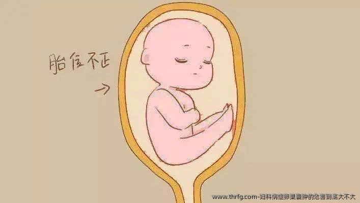 妇科病症卵巢囊肿的危害到底大不大