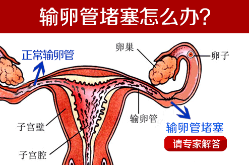 输卵管堵塞,试管婴儿手术