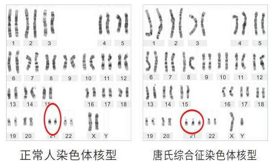 泰国三代试管婴儿,泰国三代试管婴儿阻隔染色体异常,三代试管婴儿