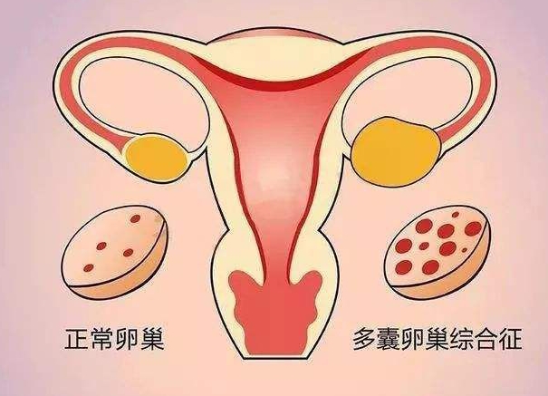 多囊卵巢做泰国试管婴儿需要注意什么？