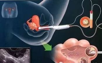 试管婴儿卵泡取出,试管婴儿胚胎