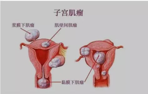 子宫问题,试管婴儿成功率