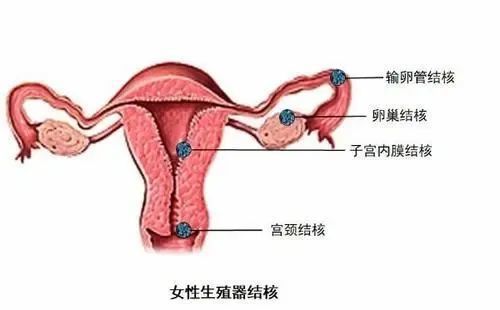 输卵管结核,第三代试管婴儿