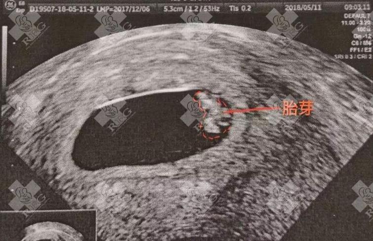 移植21天了胚胎长稳了吗?