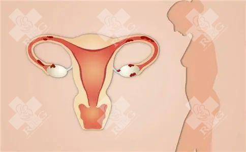 女性如何预防子宫肌炎?