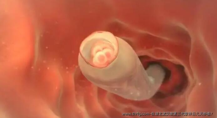 在湖北武汉做第三特需后几天移植?