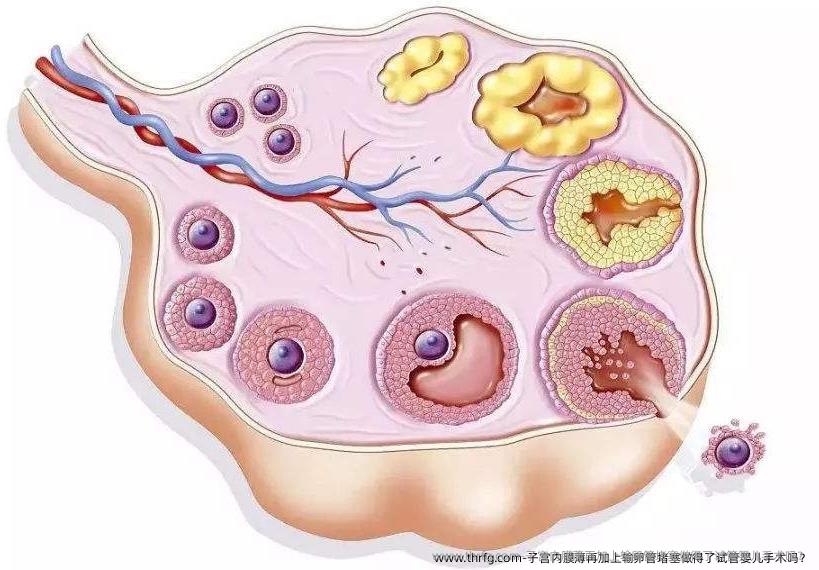 子宫内膜薄再加上输卵管堵塞做得了试管婴儿手术吗？
