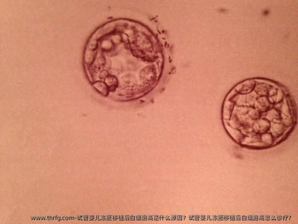 试管婴儿冻胚移植后白细胞高是什么原因？试管婴儿冻胚移植后白细胞高怎么诊疗？
