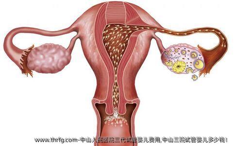 中山人民医院三代试管婴儿费用,中山三院试管婴儿多少钱！