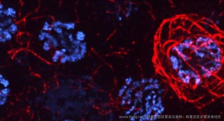 格鲁吉亚试管成功案例：格鲁吉亚试管亲身经历