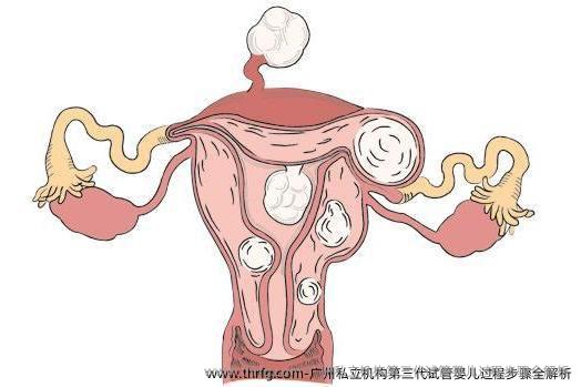 广州私立机构第三代试管婴儿过程步骤全解析